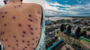 Mpox: Porto Velho registra quatro casos confirmados