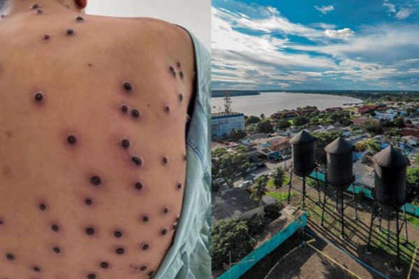 Mpox: Porto Velho registra quatro casos confirmados
