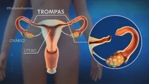 Médica explica quem pode fazer laqueadura e quais são os critérios Médica explica quem pode fazer laqueadura e quais são os critérios