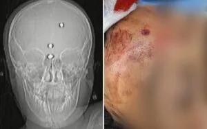 Menino baleado na cabeça acorda, volta a falar e pede para ir para casa Menino baleado na cabeça acorda, volta a falar e pede para ir para casa